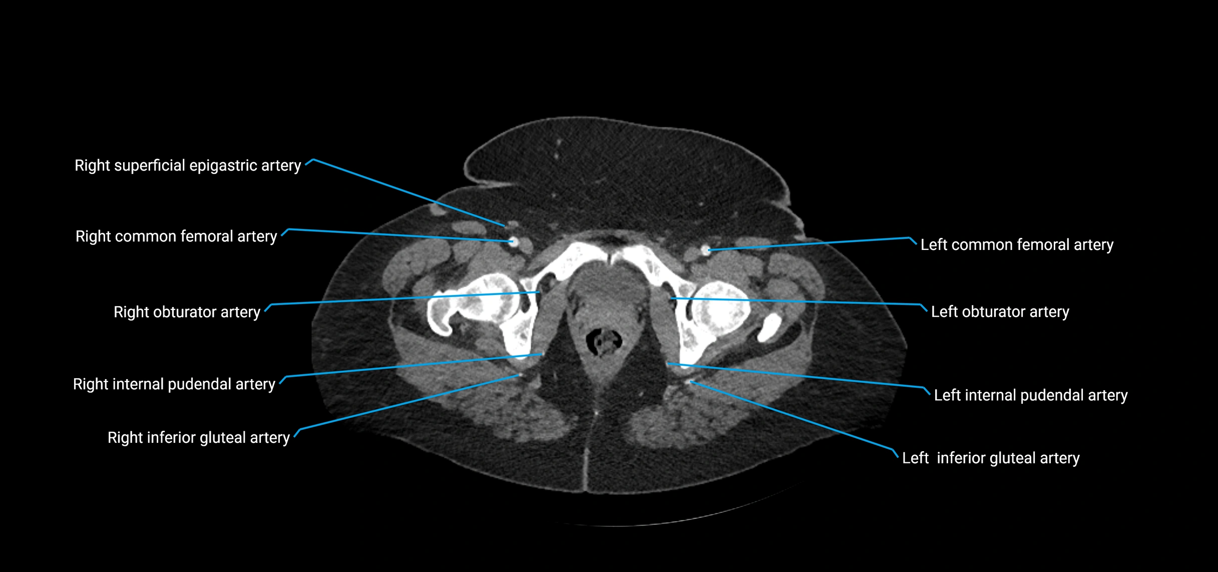 CTA abdomen axial cross sectional anatomy labelled image_255 (2).webp